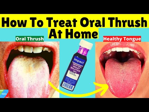 , title : 'How To Treat Oral Thrush At Home | How to Treat Candida at Home'