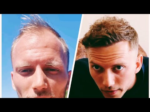 1 Year Hair Transplant Timeline - Day 0 to 365