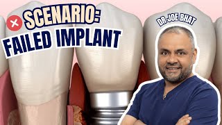 Implant Failed After 6 Months - Surgeon vs Restorative Dentist Medicolegal Considerations - GF022