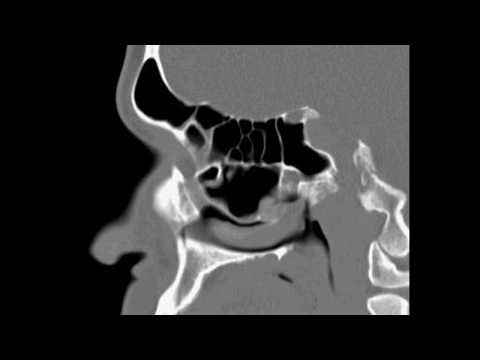 FESS Left Routine Case