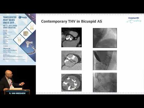 N. Van Mieghem  | TAVR will be the treatment of choice for bicuspid aortic valve disease in the f...