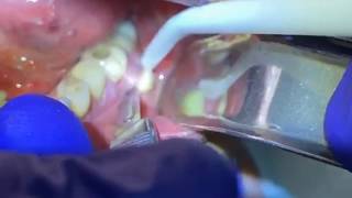 Draining a Dental Abscess | Advanced Dental Care