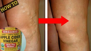 HOW TO USE APPLE CIDER VINEGAR FOR VARICOSE VEINS OR SPIDER VEINS | HOME REMEDY FOR VARICOSE VEINS