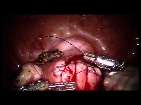 La myomectomie laparoscopique à trois ports.