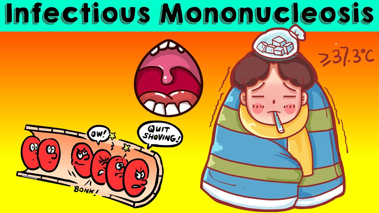 Infectious Mononucleosis (IMN/Glandular Fever) - Causes, Signs & Symptoms, Diagnosis & Treatment