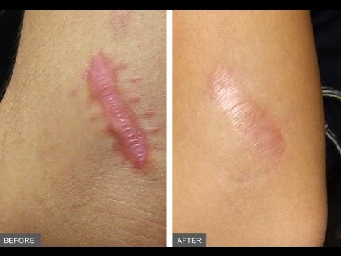 Bago at pagkatapos ng pagbaba ng timbang mga kababaihan Acupuncture sa labis na katabaan