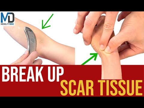 How To Break Up Scar Tissue - 6 Effective Methods
