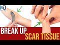 How To Break Up Scar Tissue 6 Effective Methods