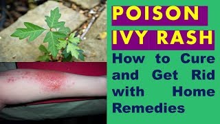 How to Cure and Get Rid of Poison Ivy Rash Fast With Home Remedies