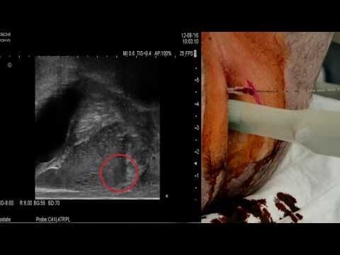 Prostamol Anweisung Kontraindikation Ultraschall der Prostata Blase