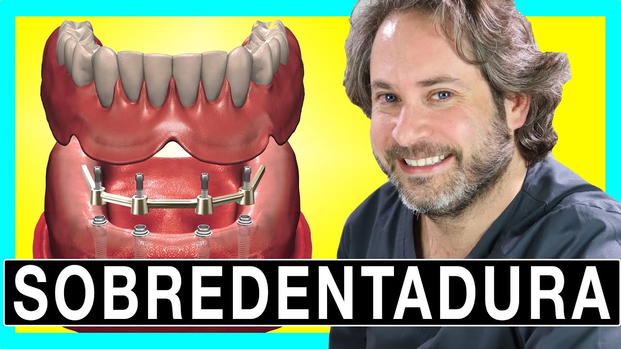 🔥𝐒𝐎𝐁𝐑𝐄𝐃𝐄𝐍𝐓𝐀𝐃𝐔𝐑𝐀 sobre 4 IMPLANTES locator [MIRALO 👌]PROTESIS REMOVIBLE sobre Implantes