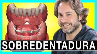 🔥𝐒𝐎𝐁𝐑𝐄𝐃𝐄𝐍𝐓𝐀𝐃𝐔𝐑𝐀 sobre 4  IMPLANTES locator [MIRALO 👌]PROTESIS REMOVIBLE sobre Implantes