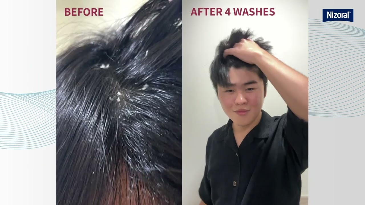 Nizoral 2% before and after 4 washes