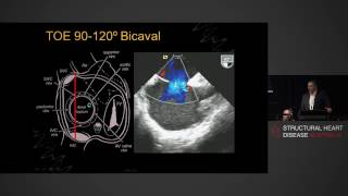 Atrial Septum – Anatomy, Echocardiography & Interventions – A/Prof Gregory Scalia