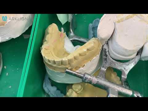 Bay Area local full service dental Lab - Arklign