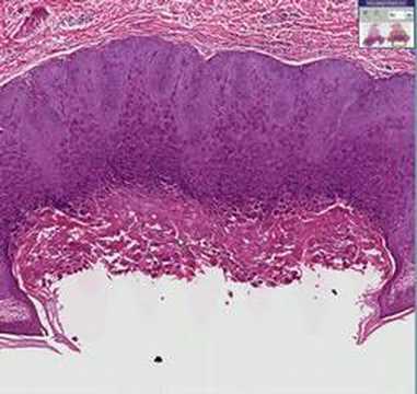 paraziták molluscum contagiosum