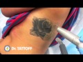 Tattoo Removal Houston Texas - Laser Tattoo Removal Procedure of Rose Tattoo