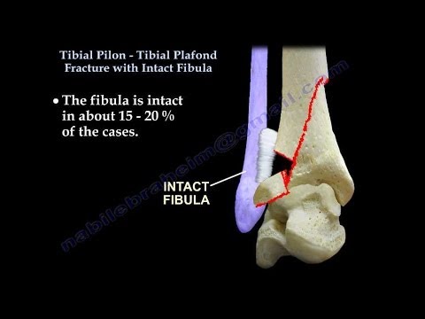 Tibiapilonfraktur mit intakter Fibula – Alles, was Sie wissen müssen – Dr. Nabil Ebraheim