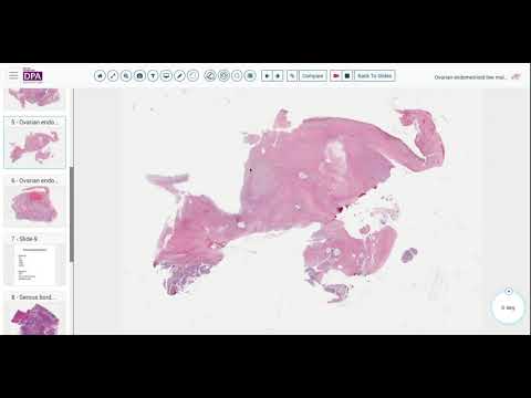 Digital Pathology Sign out 26- Borderline Endometrioid tumor