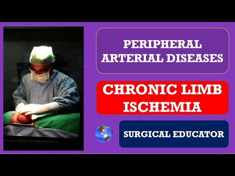 CHRONIC LOWER LIMB ISCHEMIA -  How To DIAGNOSE & TREAT/ Peripheral Arterial Diseases