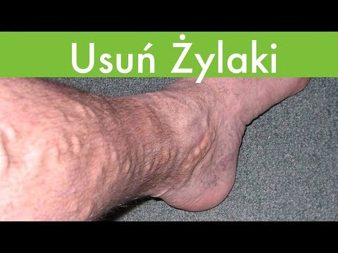 Ćwiczenia ekspandera na grupę mięśniową Bóle mięśni ćwiczenia