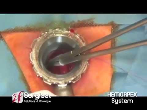 comment soigner une fissure anale sans opération