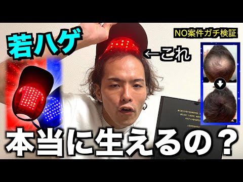 【検証】若ハゲを育毛LEDキャップは救えるのか？