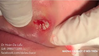 Dermatologist treating squeeze big pimples, whitehead blackhead, pustule, on the lips long video