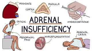 Understanding Adrenal Insufficiency