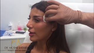 הרמה ועיצוב גבות בהזרקת חומצה היאלורונית - דר' משה שמש