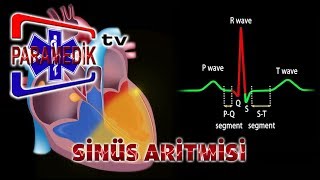 EKG - SİNÜS RİTMLERİ : Sinüs Aritmisi