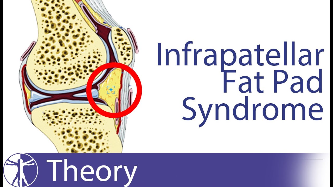 Infrapatellar Fat Pad Syndrome | Hoffa's Fat Pad