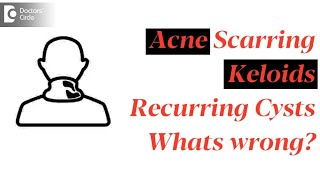 Acne scarring,keloids and recurring cysts. What is wrong? - Dr. Rasya Dixit