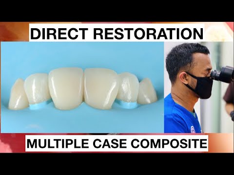 Step By Step - Layering Anterior Multiple Case Composite 