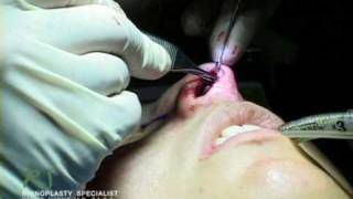 Dr. Nassif’s Closed Rhinoplasty How To – Columellar Strut