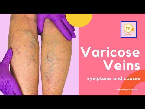 varicoza prelucrarea membrilor inferiori a ierburilor cea mai buna prevenire varicoasa