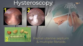 Partial septum & Fibroids Hysteroscopic surgery