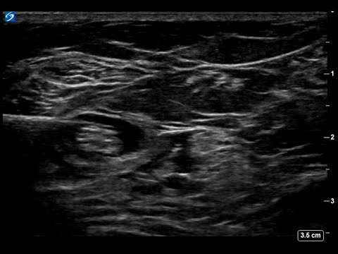 Ultrasound-Guided Popliteal Sciatic Nerve Block - Singel handed user