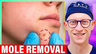 How To Get Rid of Facial Mole FOREVER