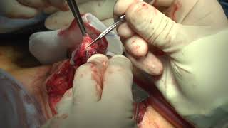 VAGINOPLASTY  - Vaginoplastie