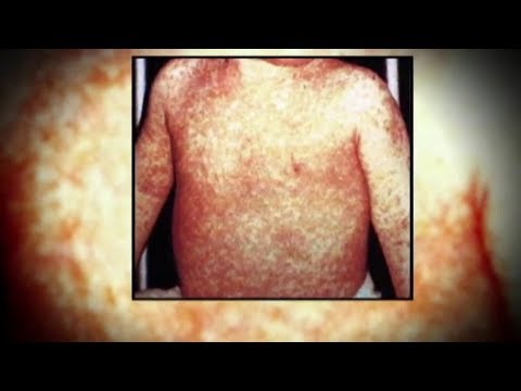 NY Rockland County Measles Outbreak