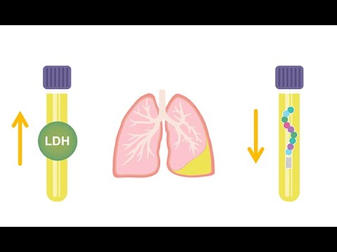 Differentiating transudative and exudative effusions transudate vs  exudate
