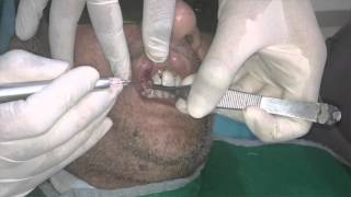 Excision of venous hemangioma of upper lip using laser