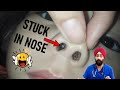 नाक से कोई चीज़ कैसे निकाले | Something Stuck in Nose | How to Remove | Dr.E