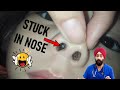 नाक से कोई चीज़ कैसे निकाले Something Stuck In Nose How 