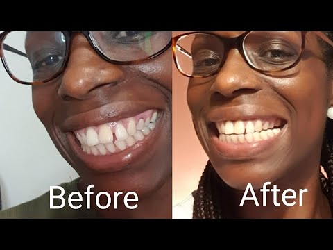 Update   2months Dr.Smile Teeth Aligners ||@Sharon Lifestyle