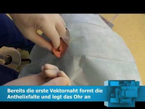 Ohren Anlegen durch Fadenmethode nach Dr. Schumacher und Dr. Becker