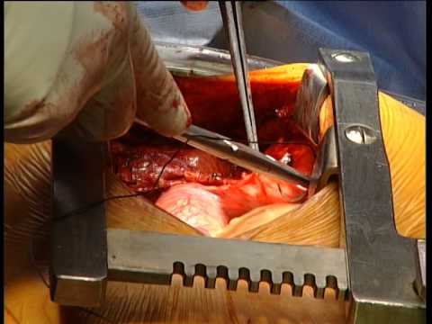 Transplantacija jeter - prim. dr. Dragan Stanisavljevič