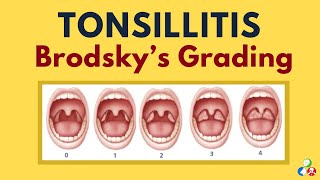 Tonsillitis Grading - Brodsky | Grades of tonsillar enlargement | ENT Viva Voce