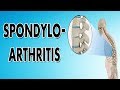 Spondyloarthropathy